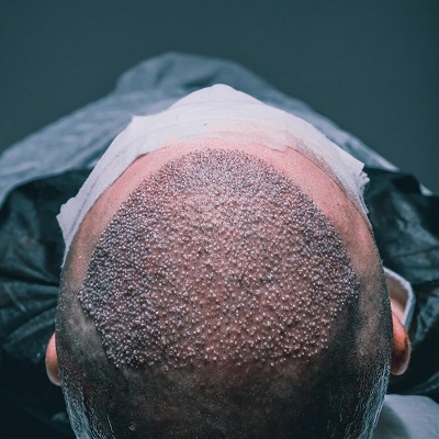 Mega and Giga Hair Transplant Sessions for Advanced Hair Loss