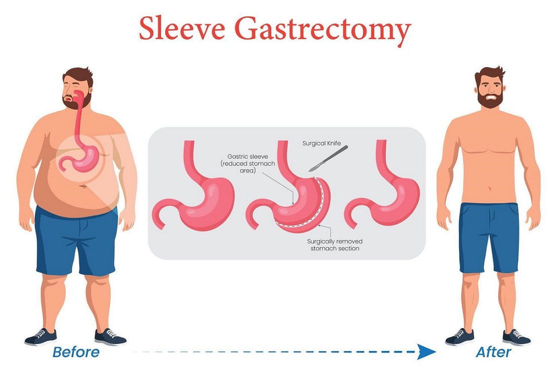 Sleeve Gastrectomy in Islamabad