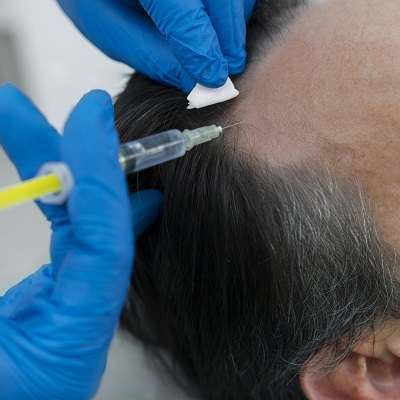 hair loss treatment in Islamabad