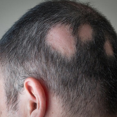 Alopecia Areata Treatment in Islamabad