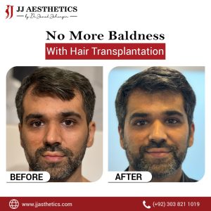 Hair Transplant Before After JJ aesthetics