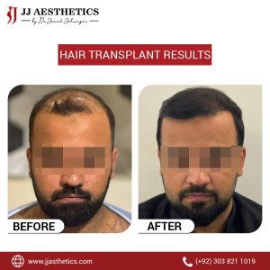 Hair Transplant results 2026