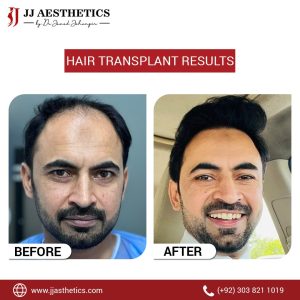 Hair Transplant results Islamabad
