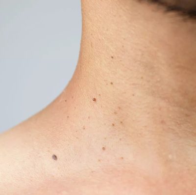 How does a dermatologist remove a skin tag?