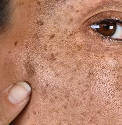 How to Remove Acne Scars and Dark Spots